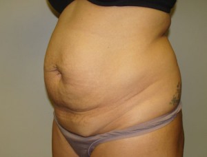 Diastasis Recti Before and After 06 | Grover Aesthetics