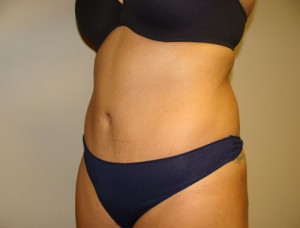 Diastasis Recti Before and After 06 | Grover Aesthetics