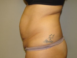 Diastasis Recti Before and After 06 | Grover Aesthetics