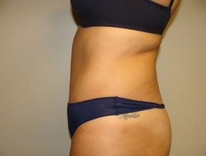Diastasis Recti Before and After 06 | Grover Aesthetics