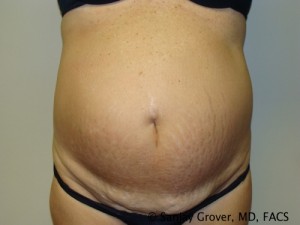 Diastasis Recti Before and After | Grover Aesthetics