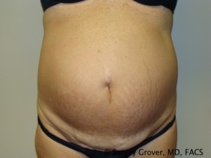 Diastasis Recti Before and After | Sanjay Grover MD FACS