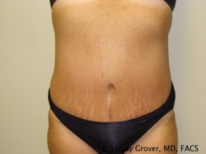 Diastasis Recti Before and After 07 | Sanjay Grover MD FACS