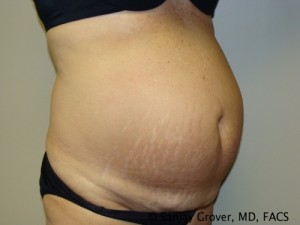 Diastasis Recti Before and After 07 | Sanjay Grover MD FACS