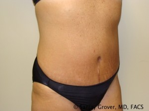 Diastasis Recti Before and After 07 | Sanjay Grover MD FACS
