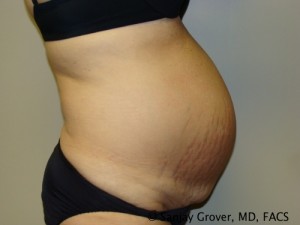 Diastasis Recti Before and After 07 | Grover Aesthetics