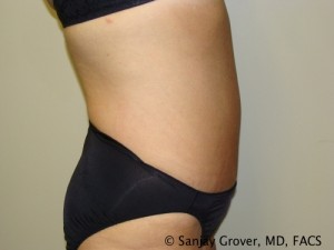 Diastasis Recti Before and After 07 | Sanjay Grover MD FACS