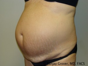 Diastasis Recti Before and After 07 | Sanjay Grover MD FACS