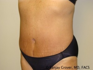 Diastasis Recti Before and After 07 | Sanjay Grover MD FACS