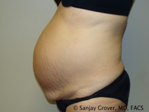 Diastasis Recti Before and After 07 | Grover Aesthetics