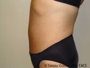 Diastasis Recti Before and After 07 | Sanjay Grover MD FACS