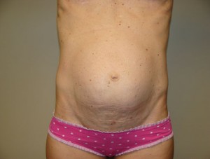 Diastasis Recti Before and After | Grover Aesthetics
