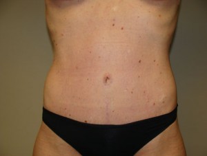 Diastasis Recti Before and After | Grover Aesthetics
