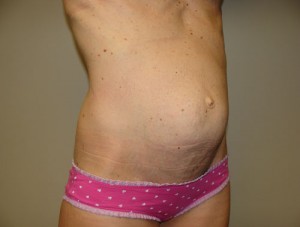 Diastasis Recti Before and After 08 | Grover Aesthetics