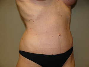 Diastasis Recti Before and After 08 | Grover Aesthetics