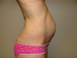 Diastasis Recti Before and After 08 | Grover Aesthetics