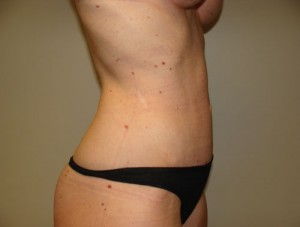Diastasis Recti Before and After 08 | Grover Aesthetics