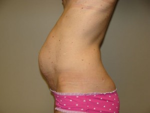 Diastasis Recti Before and After 08 | Grover Aesthetics