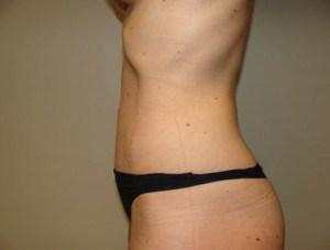 Diastasis Recti Before and After 08 | Grover Aesthetics