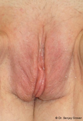 Labiaplasty Before and After 17 | Grover Aesthetics