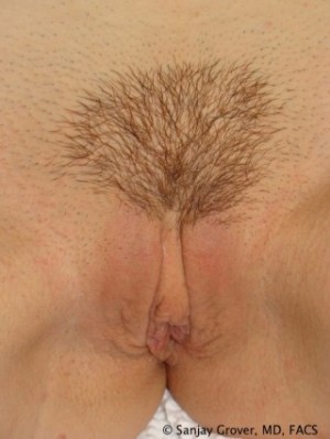 Labiaplasty Before and After | Grover Aesthetics