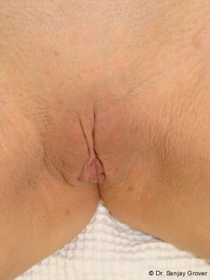 Labiaplasty Before and After 12 | Sanjay Grover MD FACS