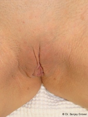 Labiaplasty Before and After | Grover Aesthetics