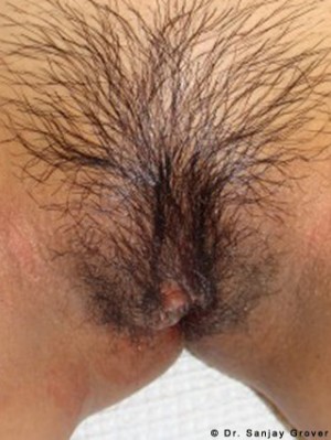 Labiaplasty Before and After | Grover Aesthetics