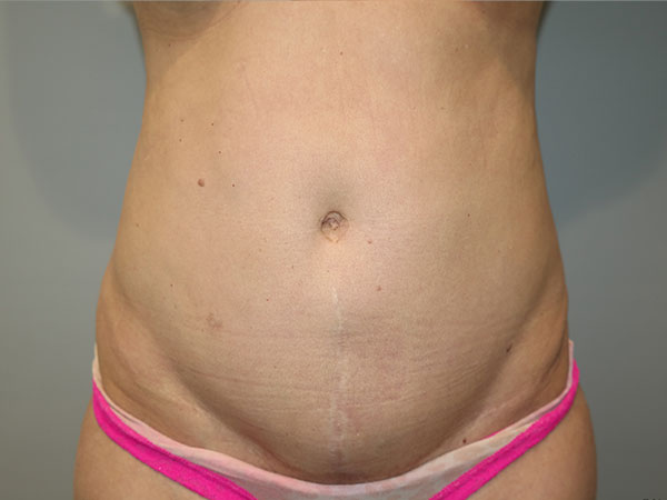 Liposuction Before and After | Grover Aesthetics