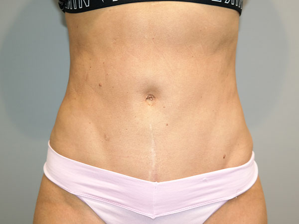 Liposuction Before and After | Sanjay Grover MD FACS