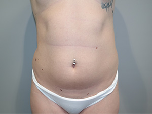 Liposuction Before and After 39 | Sanjay Grover MD FACS