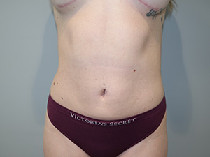 Liposuction Before and After | Sanjay Grover MD FACS