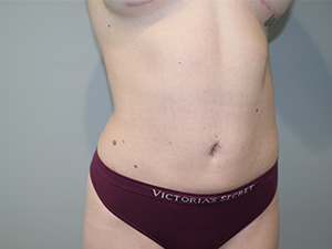 Liposuction Before and After 02 | Sanjay Grover MD FACS