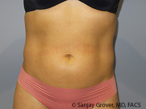 Liposuction Before and After 49 | Sanjay Grover MD FACS