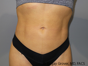 Liposuction Before and After 03 | Sanjay Grover MD FACS