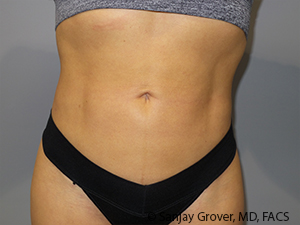 Liposuction Before and After | Sanjay Grover MD FACS