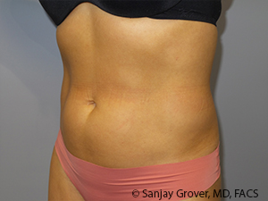 Liposuction Before and After 03 | Grover Aesthetics