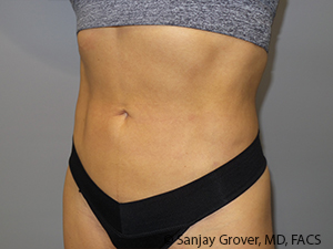 Liposuction Before and After 03 | Sanjay Grover MD FACS