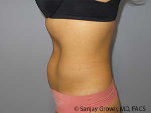 Liposuction Before and After 03 | Sanjay Grover MD FACS