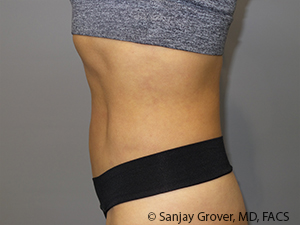 Liposuction Before and After 03 | Grover Aesthetics