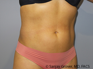 Liposuction Before and After 03 | Sanjay Grover MD FACS