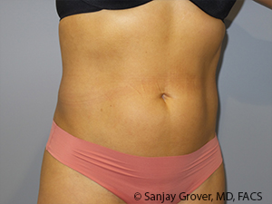 Liposuction Before and After 03 | Grover Aesthetics