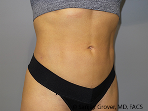 Liposuction Before and After 03 | Grover Aesthetics