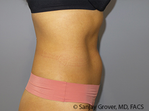 Liposuction Before and After 03 | Grover Aesthetics
