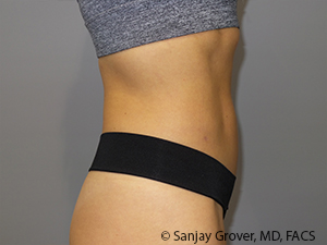 Liposuction Before and After 03 | Grover Aesthetics