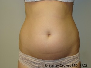 Liposuction Before and After 52 | Sanjay Grover MD FACS