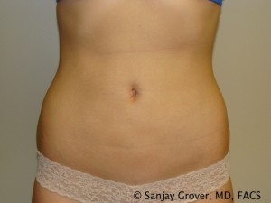 Liposuction Before and After | Sanjay Grover MD FACS