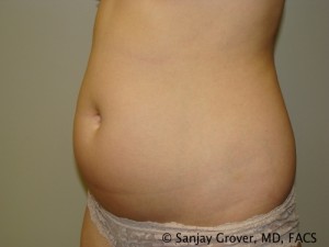 Liposuction Before and After 04 | Grover Aesthetics