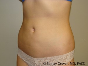 Liposuction Before and After 04 | Grover Aesthetics