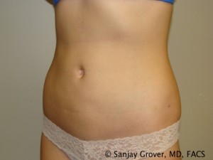 Liposuction Before and After 04 | Sanjay Grover MD FACS